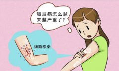 银屑病“皮肤警报”：这些症状你中招了吗？