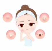 如何祛痘印预防青春痘加重