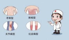 南京银屑病研究所怎么样